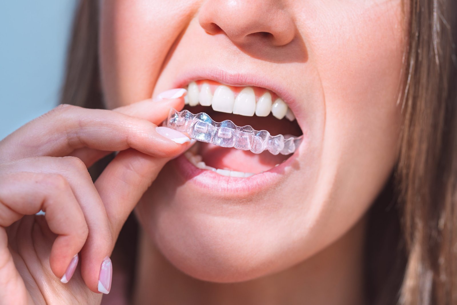 Ortodoncia con Alineadores invisibles INVISALIGN en Oral Synergy Cuenca