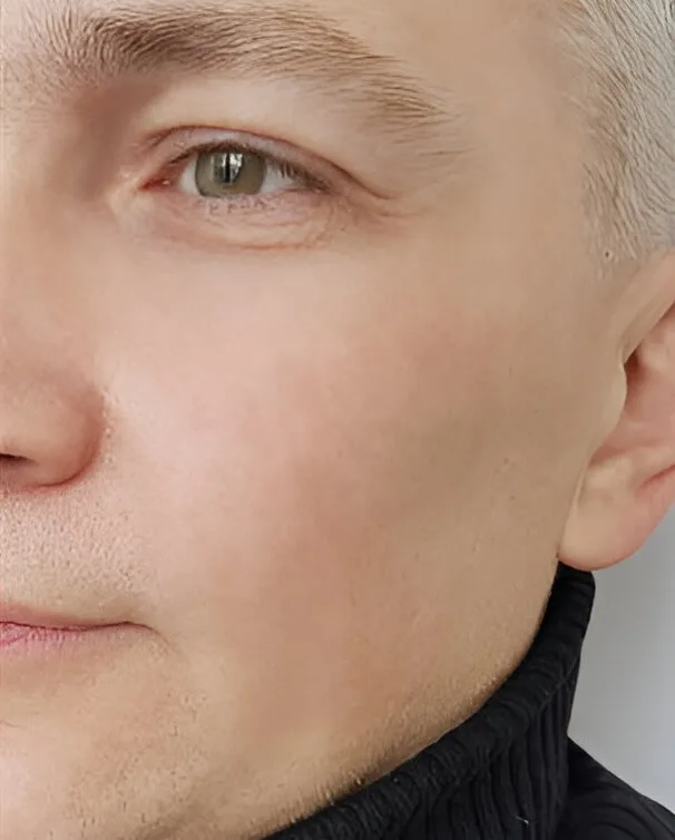 Armonizacion facial con Botox en clinica Oral Synergy Cuenca