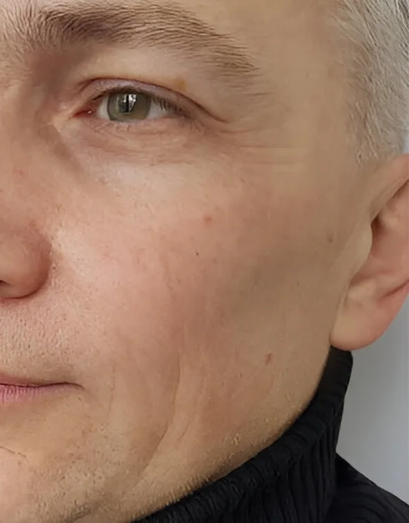 Armonizacion facial con Botox en clinica Oral Synergy Cuenca