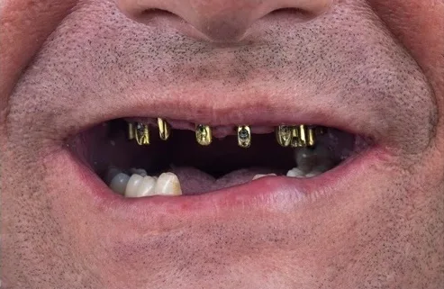 Después del tratamiento con implantes dentales en Oral Synergy en Cuenca