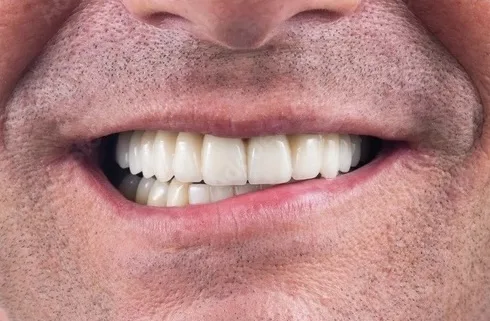 Antes del tratamiento con implantes dentales en Oral Synergy en Cuenca