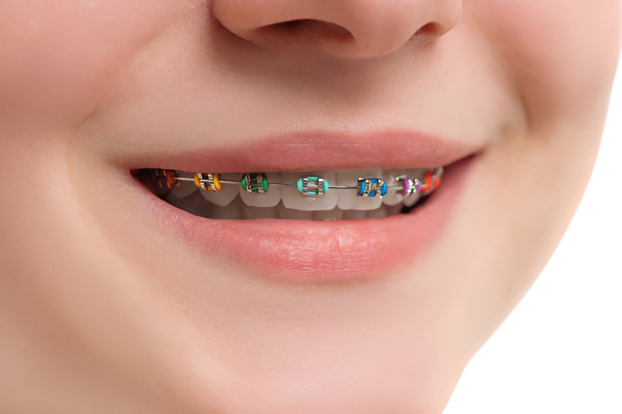 Ortodoncia con Brackets en Oral Synergy Cuenca