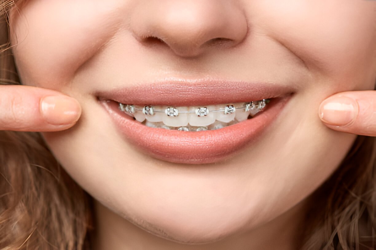 Ortodoncia con Brackets en Oral Synergy Cuenca